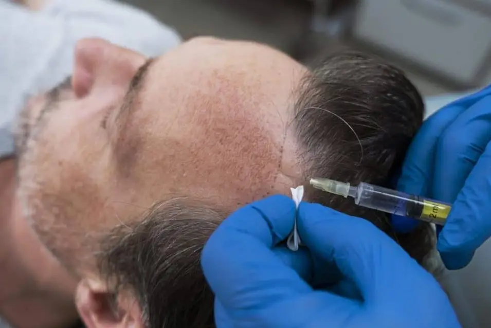 Co na wypadanie włosów u mężczyzn RosaMed Clinic Warszawa