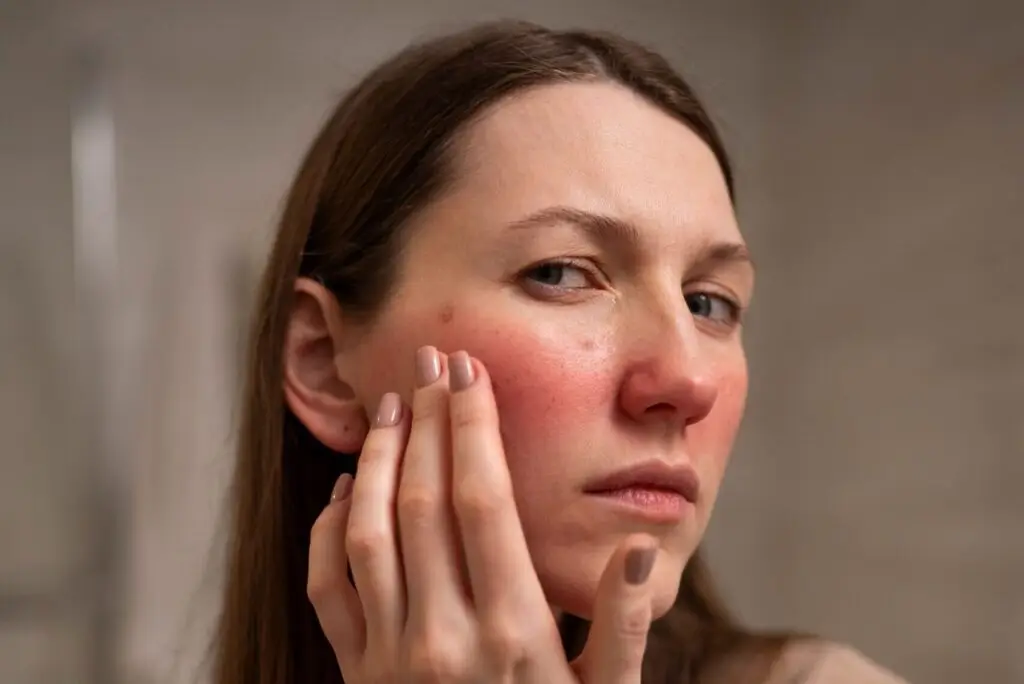 Kwas do cery naczynkowej - RosaMed Clinic